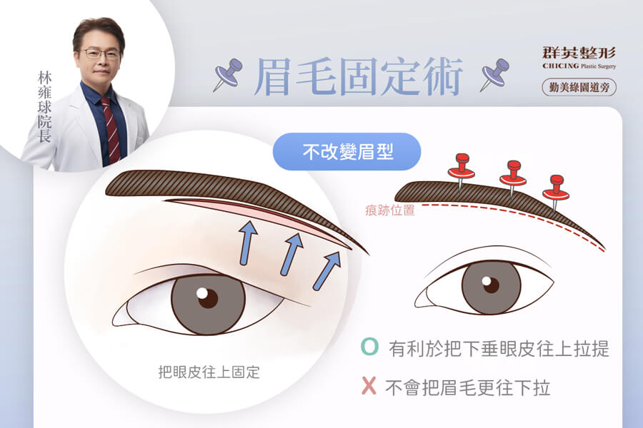 切眉 手術 或 眉下切 手術 改善 眼皮下垂＿推薦台中群英林雍球醫師