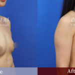台中群英 陳大正醫師 柔滴隆乳 隆乳案例