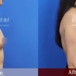 台中群英 陳大正醫師 柔滴隆乳 隆乳案例