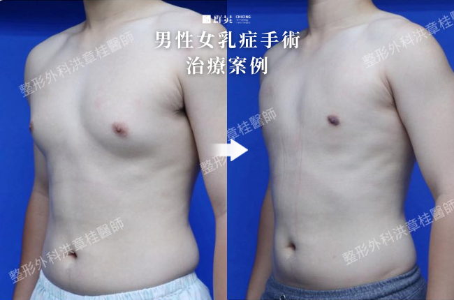 3_群英_洪章桂醫師-男性女乳症手術案例