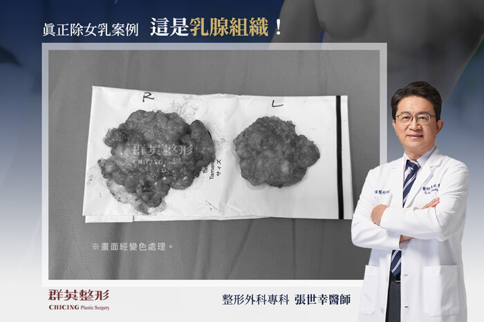 台中男性女乳症案例_群英整形外科_張世幸醫師